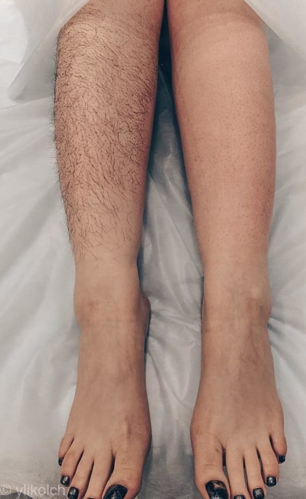 Волосы на голени вросшие, выпадают волосы на голени