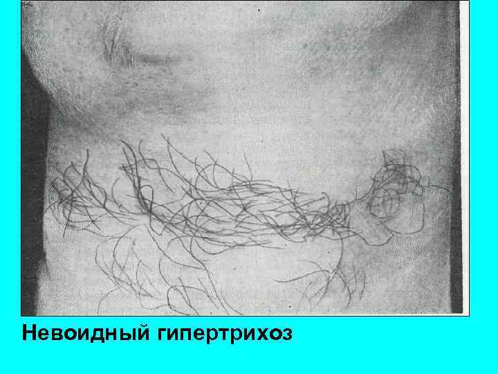 Гипертрихоз у женщин: виды, причины и лечение, типы волос