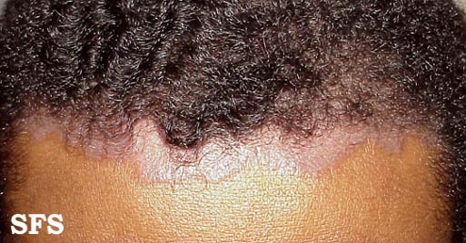 Псориаз кожи головы симптомы, диагностика и лечение