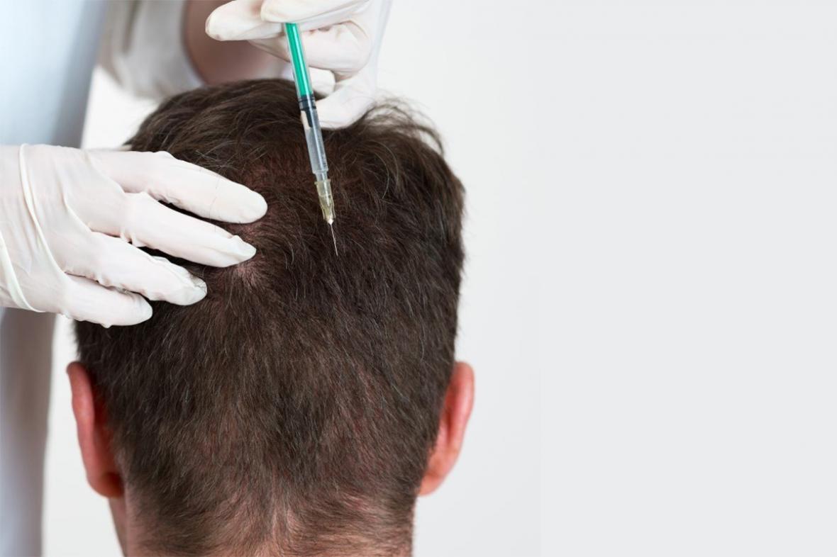Мезотерапия для волос мужчинам: показания, цена, отзывы